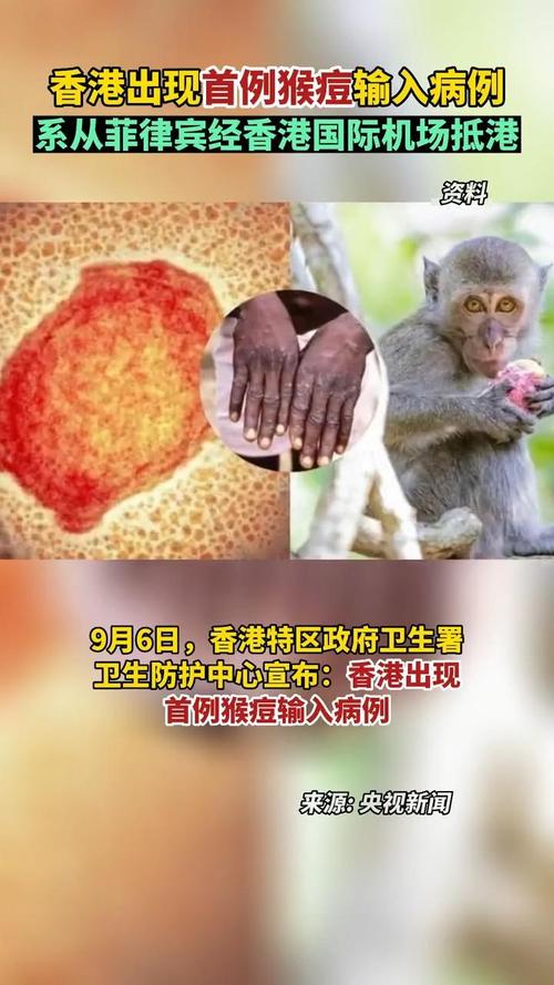菲律宾活跃猴痘病例增至5例