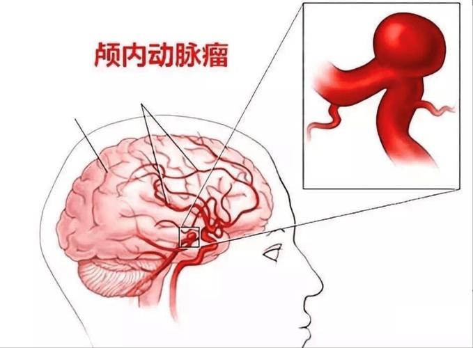 82岁老人头痛晕倒 竟是因为脑动脉瘤破裂